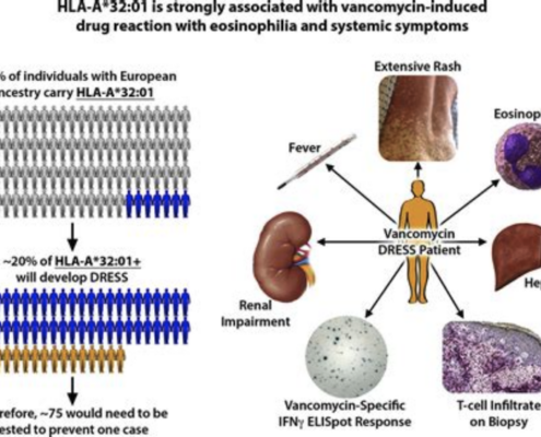 HLA-A*32:01 is strongly associated with vancomycin-induced drug reaction with eosinophilia and systemic symptoms